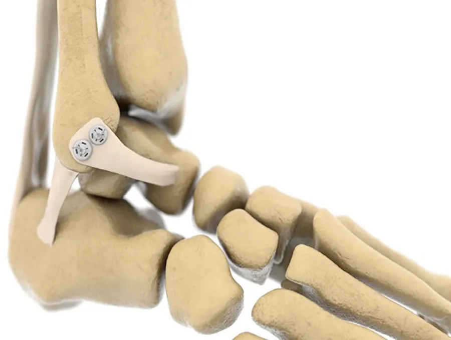 Reparación de tendones y ligamentos