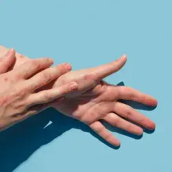 How do you catch monkeypox?